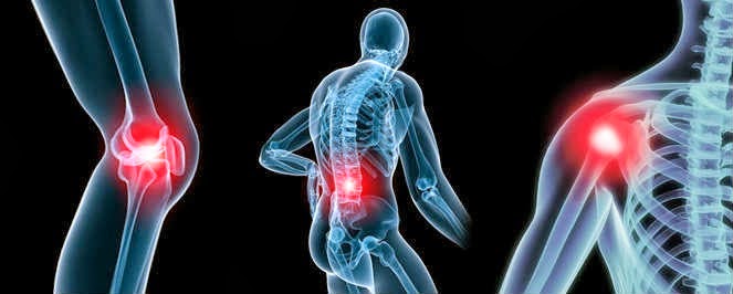 CBD et arthrose arthrite